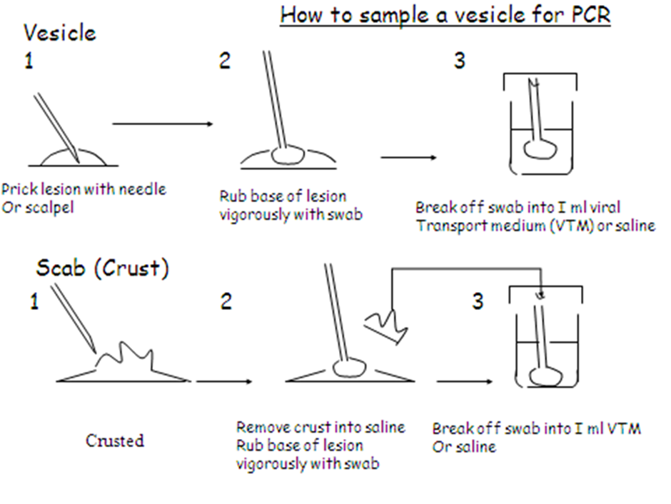 How to swab a vesicle for PCR - instructions